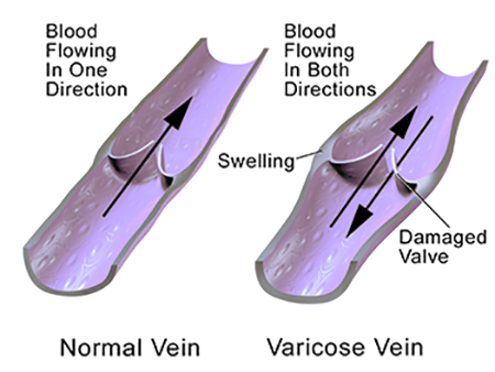 Varicose vein blood flow